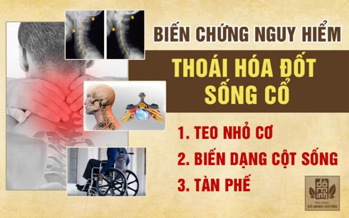 Chứng thoái hóa cột sống cổ mà nghệ sĩ Xuân Hinh mắc phải là căn bệnh nguy hiểm, cần sớm điều trị đúng cách