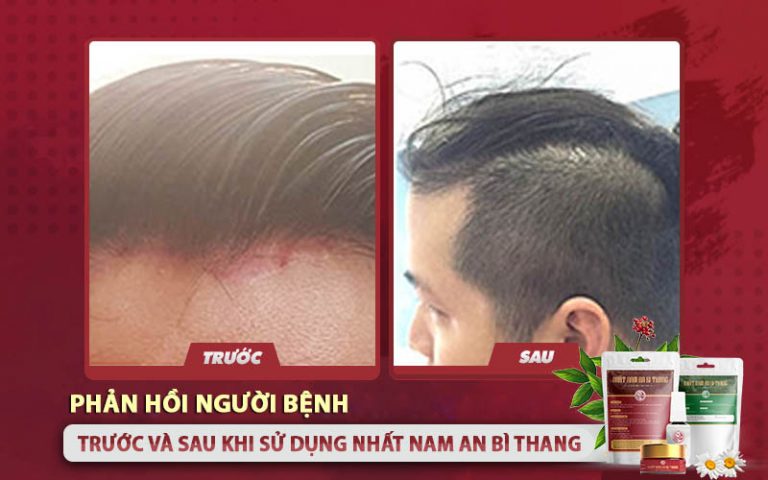 Ảnh trước và sau điều trị của bệnh nhân