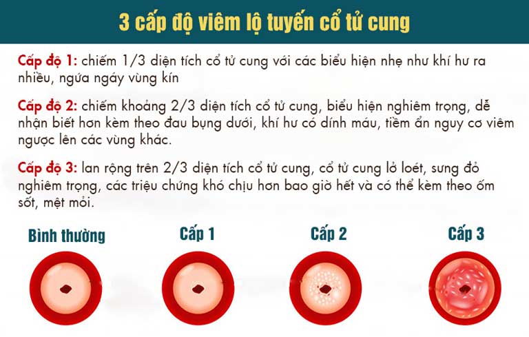 Viêm lộ tuyến cổ tử cung diễn tiến theo 3 cấp độ và cấp độ càng cao càng nguy hiểm