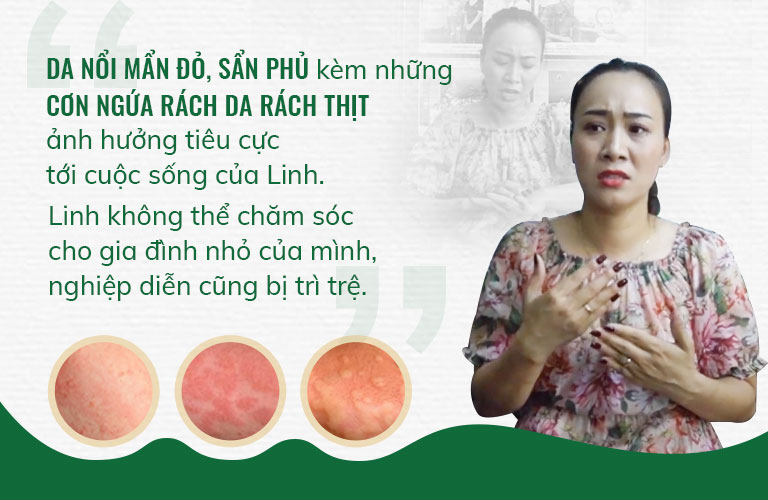 Những cơn ngứa ngáy rách da rách thịt ảnh hưởng rất nhiều tới cuộc sống của chị Linh