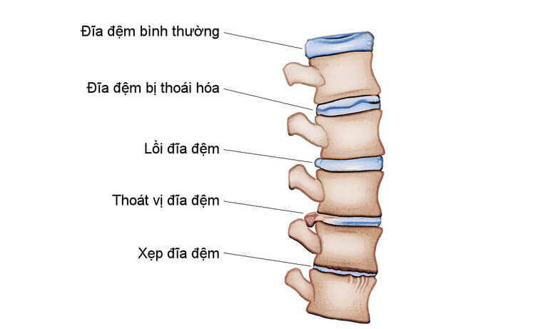 Thoái hóa cột sống là tình trạng các đĩa đệm, khớp và sụn khớp bị thoái hóa, bào mòn, biến dạng