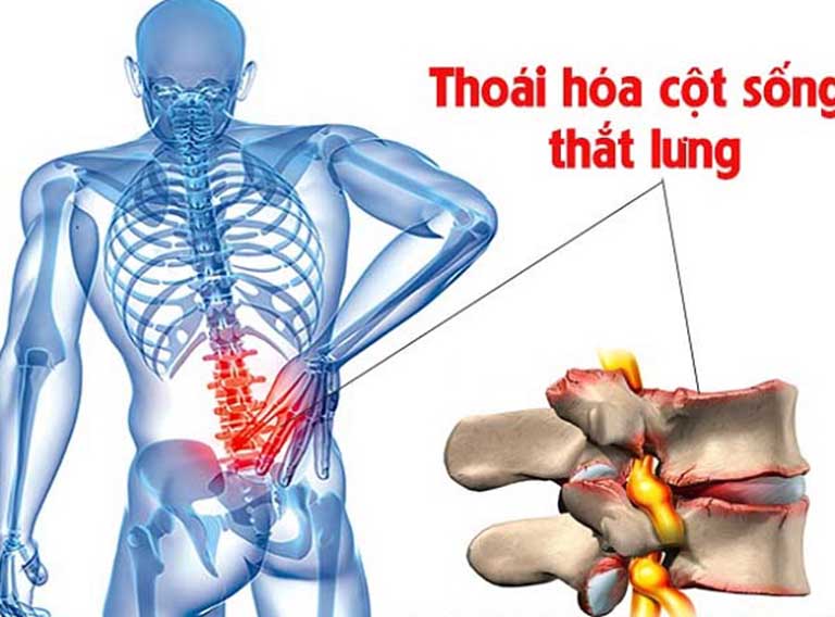 Thoái hóa cột sống thắt lưng có thể kích thích sự hình thành các gai xương