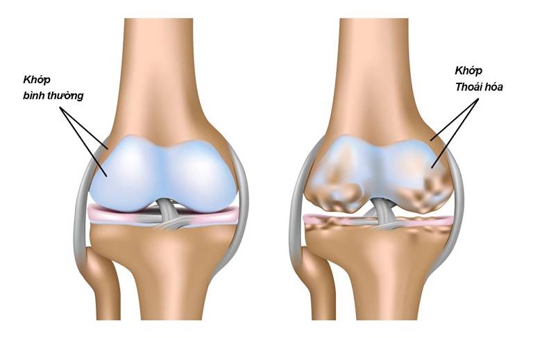 Vị trí hay xảy ra thoái hóa khớp nhất là ở đầu gối