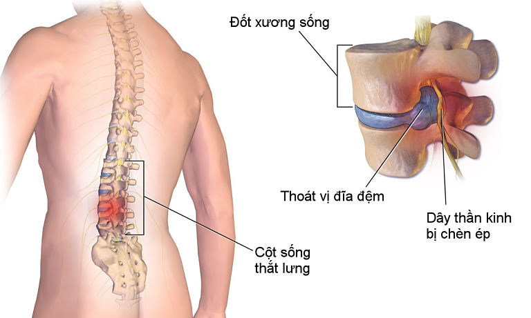 Thoát vị đĩa đệm có thể xảy ra ở bất kỳ độ tuổi nào