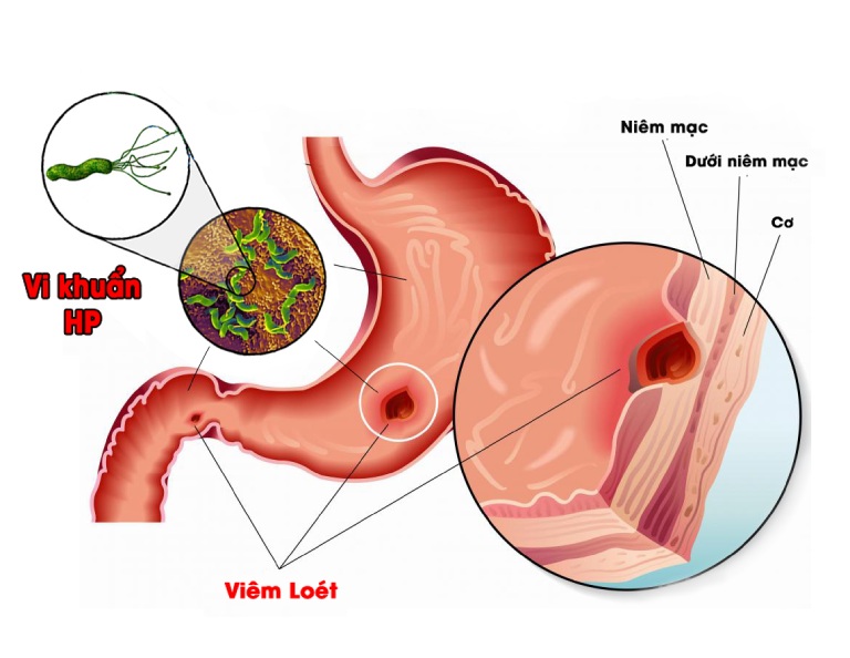 Vi khuẩn HP là một trong những nguyên nhân gây bệnh viêm dạ dày