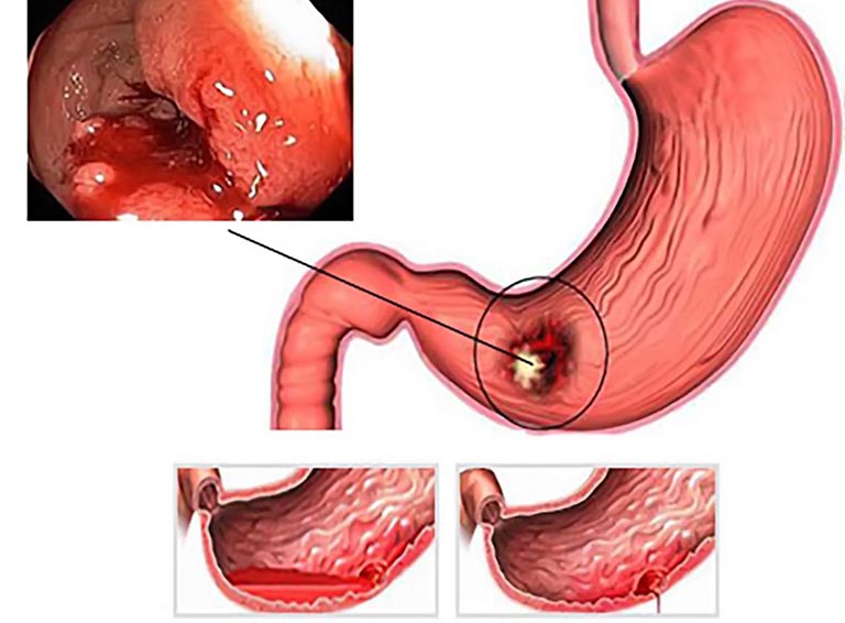 Viêm dạ dày có thể tái phát nếu không được chăm sóc cẩn thận