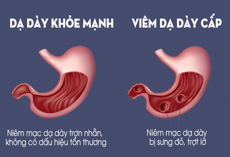 Viêm dạ dày là căn bệnh rất phổ biến ở nước ta