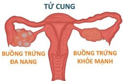 Hội chứng buồng trứng đa nang thường gặp ở đối tượng phụ nữ trong độ tuổi sinh sản