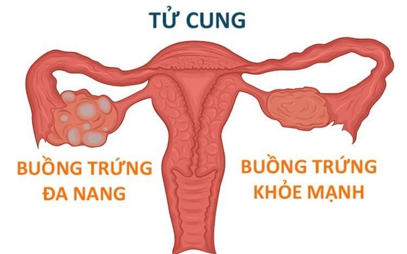 Hội chứng buồng trứng đa nang thường gặp ở đối tượng phụ nữ trong độ tuổi sinh sản