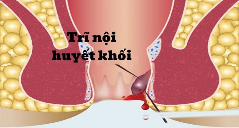 Trĩ huyết khối là một trong những biến chứng nguy hiểm mà người bị trĩ phải đối mặt