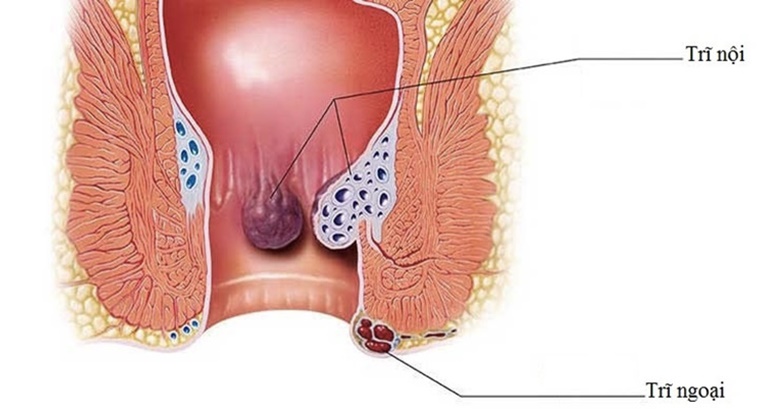 Búi trĩ lòi ra ngoài là một trong những dấu hiệu nhận biết điển hình