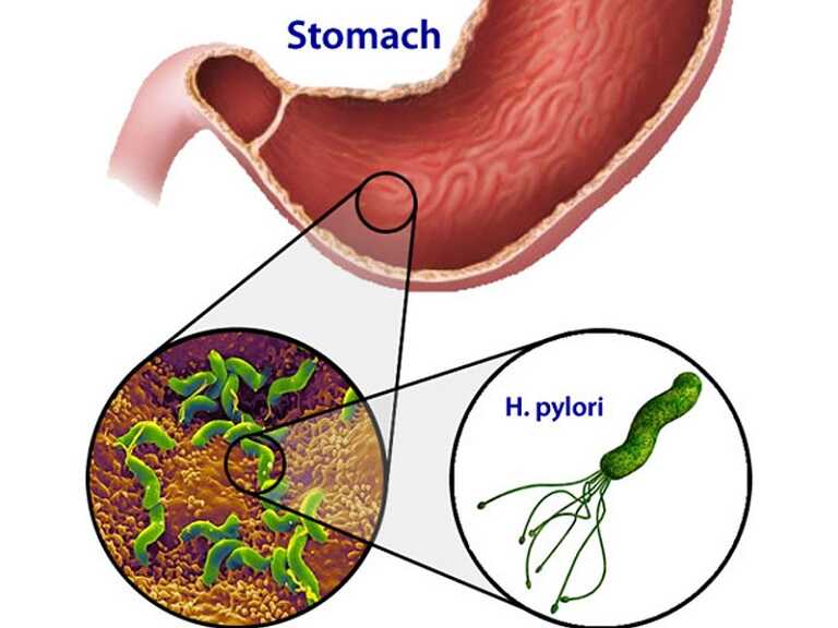 Vi khuẩn HP là gì có lây không là vấn đề được nhiều người quan tâm