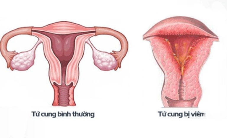 Viêm nội mạc tử cung là nguyên nhân khiến âm đạo chảy máu