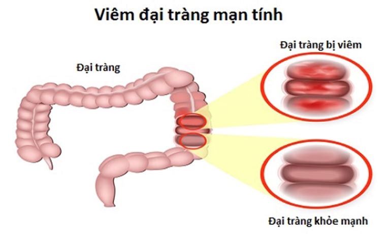 Viêm đại tràng mãn tính là một loại bệnh của hệ đường ruột