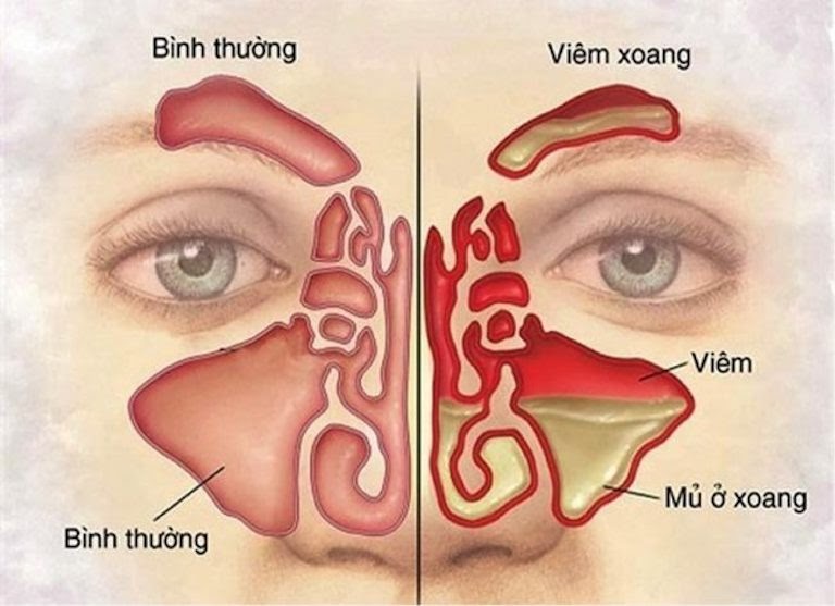 Viêm xoang là tình trạng các hốc xoang bị ứ đọng dịch nhầy và mủ