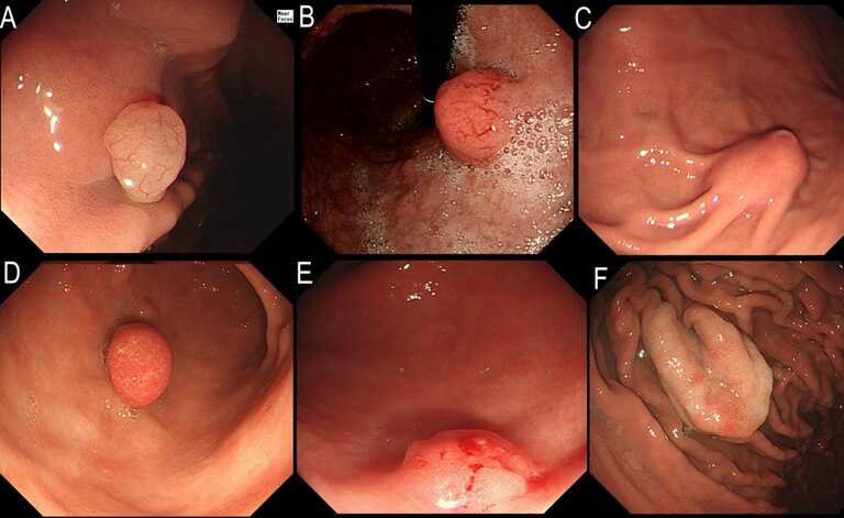 Ung thư dạ dày/ Polyp dạ dày là nguyên nhân gây ra chảy máu ở dạ dày