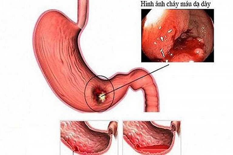 Có nhiều phương pháp chẩn đoán bệnh chảy máu bao tử