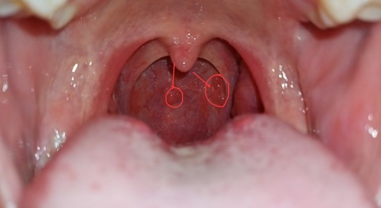 Viêm họng hạt có gây ra chứng hôi miệng không